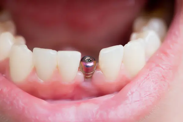 Implantat ohne Zahnkrone