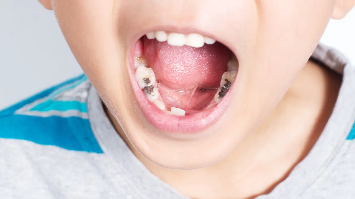 Schaden Amalgam-Füllungen der Entwicklung von Kindern?
