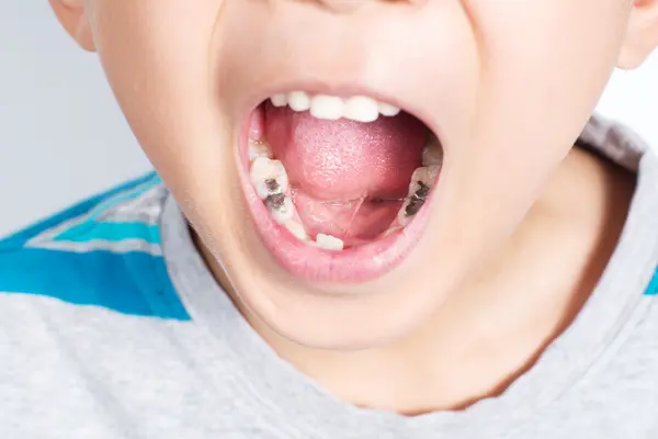 Schaden Amalgam-Füllungen der Entwicklung von Kindern?