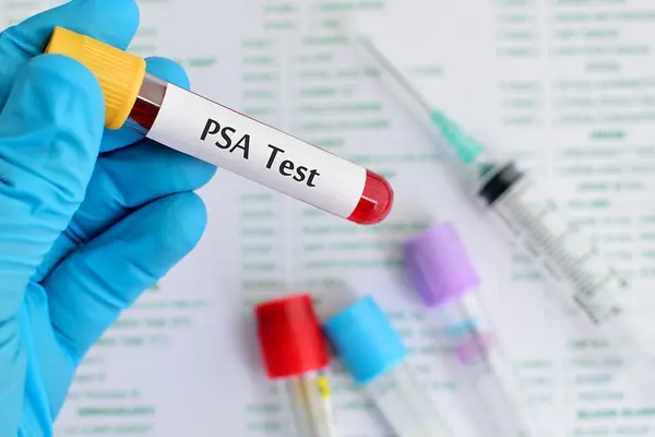 PSA Test