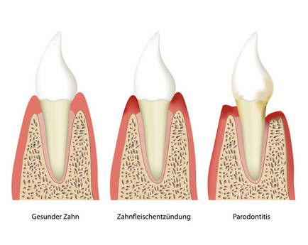 Illustration: Stufenweise Entstehung einer Parodontitis: 1. gesunder Zahn, 2. Zahnfleischentzündung, 3. Parodontitis