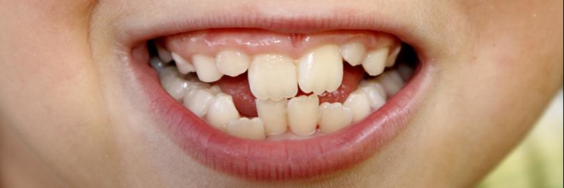 Milchzahngebiss eines Jungen mit schiefen Zähnen